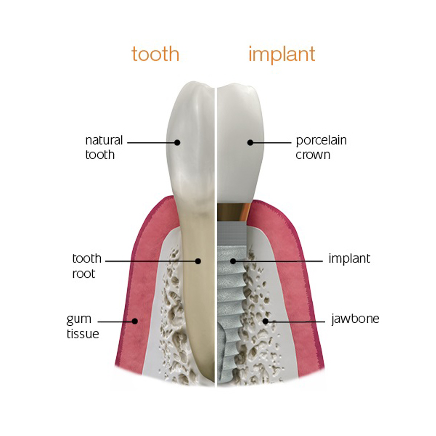 Имплантация зубов конструкция. Части импланта зуба. Строение имплантата зуба.